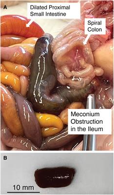 Pancreatic enzymes digest obstructive meconium from cystic fibrosis pig intestines